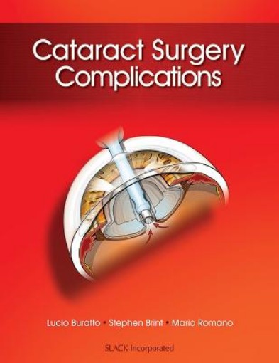 Picture of Cataract Surgery Complications