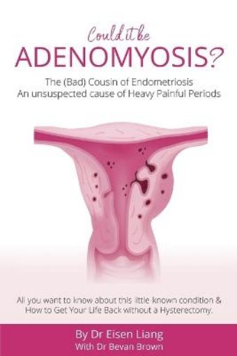 Picture of Adenomyosis -The Bad Cousin of Endometriosis